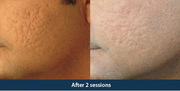 Best Acne Scars Treatment India 