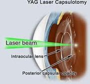 Yag Laser After Eye Surgery Delhi