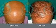 Hair Transplantation