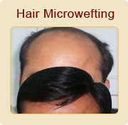 Hair Bonding Experts in India