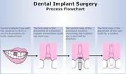 Your best Dental Implant Process is here