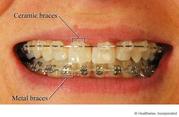 Dental Braces East Delhi