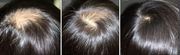 World class Hair Loss Treatment (Baldness Treatment)