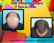 Cheap Hair Transplant in Delhi,  India at Affordable Cost