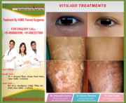 White Patches on Skin,  Vitiligo Treatment in Delhi at Dermaclinix