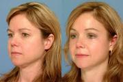 Cosmetic Plastic Surgery | Face Cosmetic Surgery | Cosmetic Surgeon De