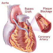 Best Heart Surgery in India at WCI