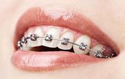 Orthodontist in Gurgaon