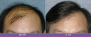 Hair transplant centre in Delhi | hair transplant cost in delhi