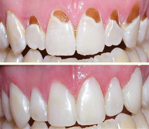 Get the Best and Affordable Treatment for Tooth Decay in Delhi - Smile