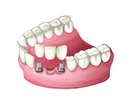 Dental implant services in Delhi - Smile Delhi The Dental Clinic