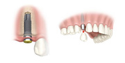 Get Best Dental implant services in Delhi,  India