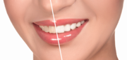 Affordable Porcelain Veneers by Smileoracles