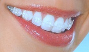 World Class Orthodontic Treatment in Delhi