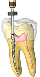 Get the Best Root Canal Treatment in Delhi