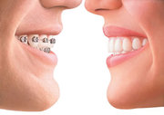 Get the Best  Invisible Braces Services in Delhi