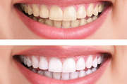 Get Affordable Teeth Whitening Treatment in Delhi - Smileoracles