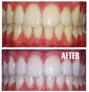 Teeth Whitening Treatment