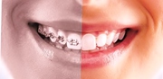 Invisible Braces in Delhi