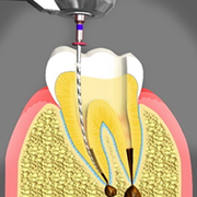 Best Root Canal Treatment in Delhi 