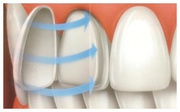 High Standard & Affordable Dental Veneers in Delhi