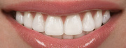 Best Porcelain Veneers in Delhi