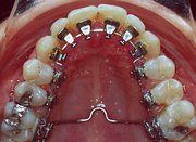 Get the Quality Lingual Braces in Delhi