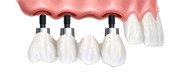 Looking for Best Dental Implant Clinic in Delhi