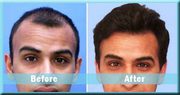 Hair Transplant in Delhi