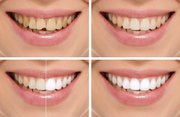 Affordable Smile Makeover in Delhi - Smile Delhi The Dental Clinic