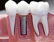 Get Affordable and Quality Dental Implants in Delhi