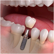 Affordable Dental Impants in Delhi at Smile Delhi The Dental Clinic