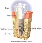 Best Dental implants treatment services in Delhi