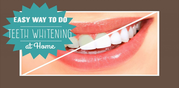 Affordable Laser Teeth Whitening Cost