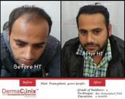 Hair Transplant Surgeon in Delhi