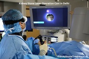 Kidney Stone Laser Operation Cost in Delhi