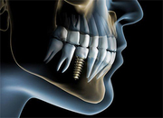 Full Mouth Dental Implants in Gurgaon