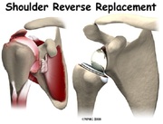 Reverse Shoulder Joint Replacement Surgery