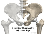 Hip Joint replaced with artificial Components