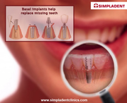 Dental Implant Services India| Immediate loading dental implants