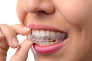 Braces Treatment in Delhi