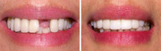 Are You Worried About Your Broken Teeth- Best Dental Implants In Delhi