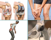 Joint Replacement Centre In Delhi