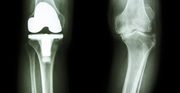 Best Joint,  Knee Replacement Hospital in Delhi NCR,  India | Primus Hos