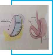  Laparoscopic Obesity/ Bariatric/ Weight Loss Surgery & Treatment