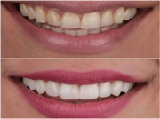 Teeth Whitening in Delhi