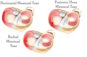 Best Meniscus Surgery in Delhi - AOSM