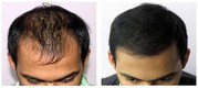 Hair Baldness Treatment by Best Hair Transplant Surgeon in Delhi