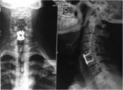 Get The Best Minimally Invasive Spine Surgery In Delhi