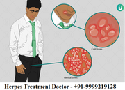 Top Herpes treatment doctor in Delhi NCR